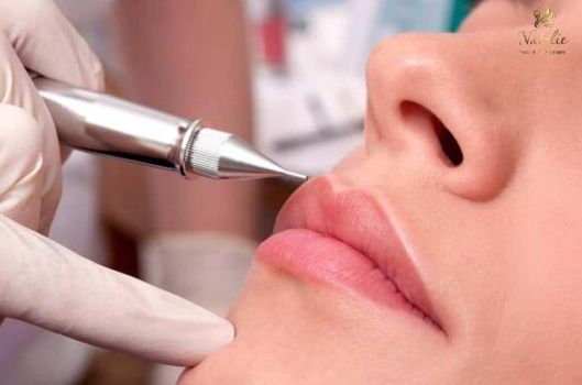 khử thâm môi bằng laser 1